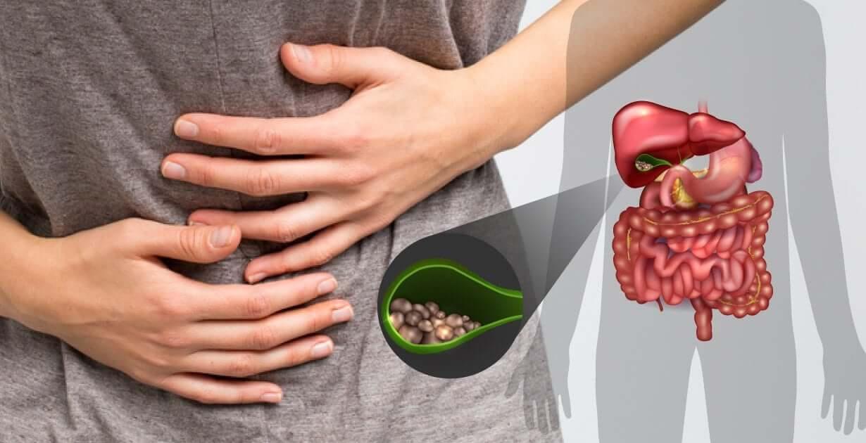 Gallstones on the Keto Diet